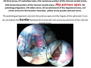 CR clival recess, ET eustachian tube, ICAc cavernous portion of the internal carotid artery,
ICAh horizontal portion of the internal carotid artery, PAp petrous apex, PLL
petrolingual ligament, VN vidian nerve, V2 second branch of the trigeminal nerve, red
arrow artery for the foramen rotundum, yellow arrow greater petrosal nerve.
The petrolingual ligament connects the petrous apex and the lingula of the sphenoid. It can
be considered the border between the horizontal and cavernous portions of the internal
carotid artery.
 