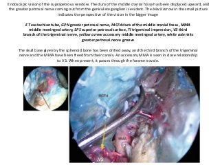 Endoscopic vision of the suprapetrous window. The dura of the middle cranial fossa has been displaced upward, and
the greater petrosal nerve coming out from the geniculate ganglion is evident. The black arrow in the small picture
indicates the perspective of the vision in the bigger image
ET eustachian tube, GPN greater petrosal nerve, MCFd dura of the middle cranial fossa, MMA
middle meningeal artery, SPS superior petrosal surface, TI trigeminal impression, V3 third
branch of the trigeminal nerve, yellow arrow accessory middle meningeal artery, white asterisks
greater petrosal nerve groove
The skull base given by the sphenoid bone has been drilled away, and the third branch of the trigeminal
nerve and the MMA have been freed from their canals. An accessory MMA is seen in close relationship
to V3. When present, it passes through the foramen ovale.
 