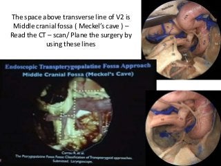 The space above transverse line of V2 is
Middle cranial fossa ( Meckel’s cave ) –
Read the CT – scan/ Plane the surgery by
using these lines
 