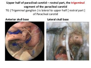 Upper half of paraclival carotid – rostral part, the trigeminal
segment of the paraclival carotid
TG ( Trigeminal ganglion ) is lateral to upper half [ rostral part ]
of Paraclival carotid
Anterior skull base Lateral skull base
 