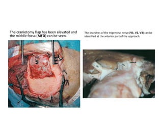 Petrous apex =Anterior Triangular ( T ) area +
Posterior Quadrangular ( Q ) area
 