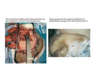 Approach through posterior Quadrangular ( Q ) area =
Kawase approach or Anterior Transpetrosal approach
Neurosurgeons are doing FTOZ + kawase approach to get control of middle
cranial fossa & posterior cranial fossa respectively
For FTOZ + Kawase approach click
1. https://www.youtube.com/watch?v=qgItZDwRYjk
2. https://www.youtube.com/watch?v=M89uijtuzQA
3. https://www.youtube.com/watch?v=es-U3QitxdY
4. https://www.youtube.com/watch?v=vDGO4kVy0Gc
5. http://www.aiimsnets.org/skull_base_tumors.asp
6. http://aiimsnets.org/AnteriorTranspetrosalapproach.asp#
others
https://www.youtube.com/results?search_query=frontotemporal+orbitozygo
matic+approach
https://www.youtube.com/results?search_query=kawase+approach
 