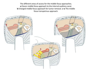 Superior view of the right petroclival area: see the relationships between the
petrous apex, the Vth nerve, and the petroclival area. VI 6th Cranial nerve; PCa posterior
cerebral artery; RCP right cerebral peduncle; SCA superior cerebellar artery; CO cochlea;
GG gasserian ganglion; PCA petrous carotid artery; IPS inferior petrosal sinus; AFB
acousticofacial bundles
 