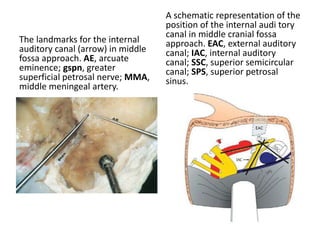 Superior view of a right middle cranial fossa following drilling and dissection of
the petrous bone: see the right tympanic cavity, and its relationships. GG Gasserian
ganglion; ET Eustachian tube; PCA petrous carotid artery; IPS inferior petrosal sinus; V
5th cranial nerve; PN petrosal nerve; CO cochlea; G geniculate ganglion; CN cochlear
nerve; FN facial nerve; ETE Eustachian tube entrance; M malleus; U uncus; SSCC
superior semicircular canal; LSCC lateral semicircular canal; SPS superior petrosal sinus
 