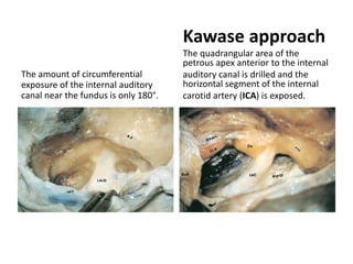 Petrous apex – Triangular area
Petrous apex – Quadrangular area
 