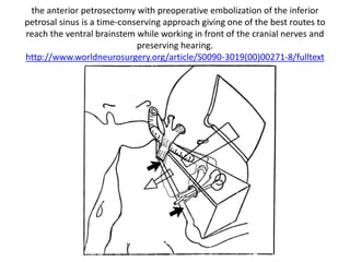 Quadrangular ( Q ) space in anterior skull base – where
petrous apex is seen – Supra-petrous approach – space
between laceral carotid & Trigeminal ganglion & V3
 