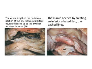Quadrangular ( Q ) space – where petrous apex is seen – Supra-
petrous approach – space between laceral carotid & Trigeminal
ganglion & V3
Quadrangular ( Q ) area in
middle cranial fossa
Quadrangular ( Q ) space in
anterior skull base approach
 