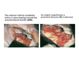 JT= Jugular Tubercle – Below this
tubercle is hypoglossal canal & above
is Internal Jugular foramen
 