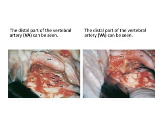 IPS & HVP hypoglossal
venous plexus
 