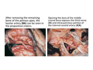 Petrous apex - Quadrangular area
 
