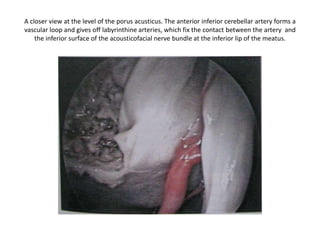 Middle cranial fossa approach
 
