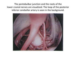 The middle fossa retractor is fixed at the petrous
ridge (PR).
AE Arcuate eminence, GPN Greater petrosal
nerve, M Middle meningeal
artery
The expected location of the internal auditory canal
(IAC).
The bar-shaded areas are the locations for drilling. A
Anterior, AE Arcuate
eminence, GPN Greater petrosal nerve, MMA Middle
meningeal
artery, P Posterior
 