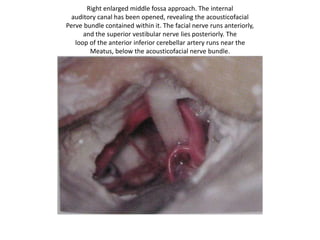 Approaches to petrous apex
LATERAL SKULL BASE
1. From above the labyrinth
a. Middle cranial fossa transpetrous
[ = Trans-apical ] approach
2. From posterior to the labyrinth
a. Retrolabyrinthine transpetrous
[ = Trans-apical ] approach /
endoscopic retrolabyrinthine
approach
3. From through the labyrinth
a. Translabyrinthine transpetrous
[ = Trans-apical ] approach
b. Transcochlear transpetrous
[ = Trans-apical ] approach
4. From below the labyrinth
a. Infralabyrinthine/Infra-otic =
Infratemporal fossa type A
transpetrous [ = Trans-apical ]
approach
b. POTS
c. Infralabyrinthine/Infra-otic =
Infratemporal fossa type B & C
transpetrous [ = Trans-apical ]
approach
ANTERIOR SKULL BASE
1. From anterior to the labyrinth
a. Suprapetrous approach
b. Infrapetrous approach
 