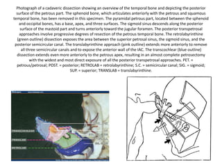 The skin and subcutaneous tissues
have been elevated as one flap.
 