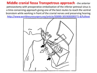 The temporalis fascia has been harvested and the
temporalis muscle cut using monopolar diathermy.
 