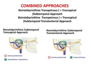 The craniotomy flap has been elevated and
the middle fossa (MFD) can be seen.
The branches of the trigeminal nerve (V1, V2, V3) can be
identified at the anterior part of the approach.
 