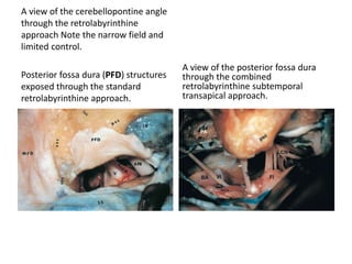 The Fukushima middle cranial fossa retractor has
been applied to maintain the elevated dura.
Three-quarters of the canal circumference is
skeletonized, leaving a thin shell of bone over it.
 