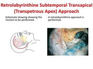The landmarks for the internal
auditory canal (arrow) in middle
fossa approach. AE, arcuate
eminence; gspn, greater
superficial petrosal nerve; MMA,
middle meningeal artery.
A schematic representation of the
position of the internal audi tory
canal in middle cranial fossa
approach. EAC, external auditory
canal; IAC, internal auditory
canal; SSC, superior semicircular
canal; SPS, superior petrosal
sinus.
 