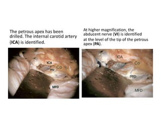 the anterior petrosectomy with preoperative embolization of the inferior
petrosal sinus is a time-conserving approach giving one of the best routes to
reach the ventral brainstem while working in front of the cranial nerves and
preserving hearing.
http://www.worldneurosurgery.org/article/S0090-3019(00)00271-8/fulltext
 