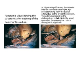Neurosurgeons are doing FTOZ + kawase approach to
get control of middle cranial fossa & posterior cranial
fossa respectively
For FTOZ + Kawase approach click
1. https://www.youtube.com/watch?v=qgItZDwRYjk
2. https://www.youtube.com/watch?v=M89uijtuzQA
3. https://www.youtube.com/watch?v=es-U3QitxdY
4. https://www.youtube.com/watch?v=vDGO4kVy0Gc
5. http://www.aiimsnets.org/skull_base_tumors.asp
6. http://aiimsnets.org/AnteriorTranspetrosalapproach.asp#
others
https://www.youtube.com/results?search_query=frontotemporal+orbitozygo
matic+approach
https://www.youtube.com/results?search_query=kawase+approach
 