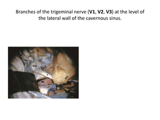 Surgical Anatomy after Opening of the Dura
The middle fossa transpetrous approach.
 