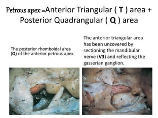 Middle cranial fossa transpetrous
approach
 