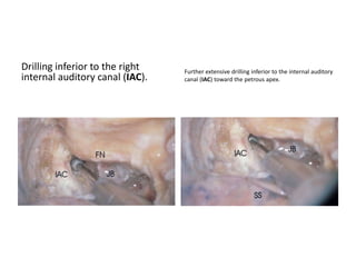 A closer view at the level of the fundus of
the internal
auditory canal. The facial nerve lies
anteriorly and superiorly. The vestibular
nerve posteriorly is separated from the
facial nerve by a plane of cleavage. The
cochlear nerve is
located inferior to the facial nerve.
The cochlear nerve travels along an inferior
course
in the internal auditory canal. Inferior to the
vestibular nerve
at the porus acusticus, it becomes inferior to the
facial nerve
at the lateral end of the internal auditory canal.
There is a
labyrinthine artery coursing between the
cochlear and facial
nerves.
 