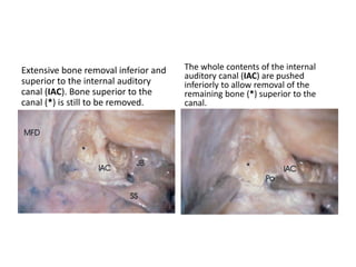A closer view at the level of the porus acusticus. The anterior inferior cerebellar artery forms a
vascular loop and gives off labyrinthine arteries, which fix the contact between the artery and
the inferior surface of the acousticofacial nerve bundle at the inferior lip of the meatus.
 