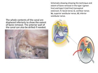 The root exit zone of the facial nerve
is anterior to the root of the cochlear
nerve and superior to the rootlets of
the lower cranial nerves.
7 Facial nerve
8 Vestibulocochlear nerve
9 Glossopharyngeal nerve
10 Vagus nerve
AICA Anterior inferior cerebellar artery
IAC Internal auditory canal
PICA Posterior inferior cerebellar artery
 