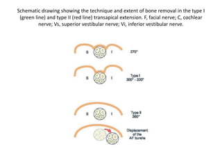 The pontobulbar junction and the roots of the
lower cranial nerves are visualized. The loop of the posterior
inferior cerebellar artery is seen in the background.
 