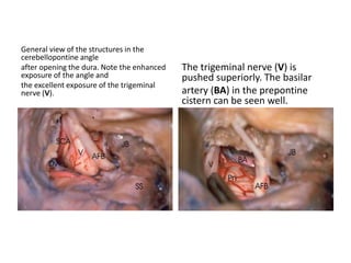 Right enlarged middle fossa approach. The internal
auditory canal has been opened, revealing the acousticofacial
Perve bundle contained within it. The facial nerve runs anteriorly,
and the superior vestibular nerve lies posteriorly. The
loop of the anterior inferior cerebellar artery runs near the
Meatus, below the acousticofacial nerve bundle.
 