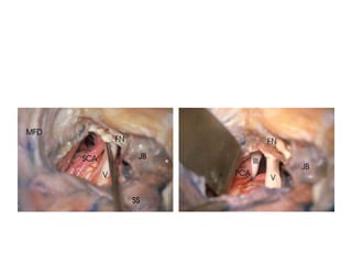 Lateral view of CP angle
 