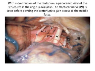 Posterior view of CP angle
1. level 1 = Trigeminal area
2. Level 2 = AFB area
3. Level 3 = Lower cranial nerve area
4. Level 4 = Foramen magnum area
 
