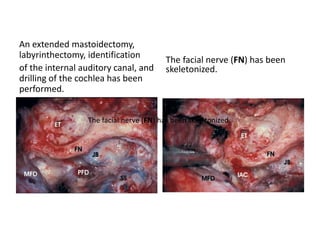 Middle cranial fossa Transpetrous approach - the anterior
petrosectomy with preoperative embolization of the inferior petrosal sinus is
a time-conserving approach giving one of the best routes to reach the ventral
brainstem while working in front of the cranial nerves and preserving hearing.
http://www.worldneurosurgery.org/article/S0090-3019(00)00271-8/fulltext
 