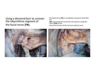 Retrolabyrinthine Transpetrous (
= Transapical )
 