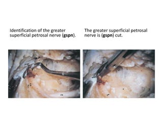 Retrolabyrinthine Transpetrous ( = Transapical ) &
Translabyrinthine Transpetrous ( = Transapical ) &
Transcochlear Transpetrous ( = Transapical )
predominently to reach
Level 1 = Trigeminal nerve area & Level 2 = AFB area
==================================================
Infralabyrinthine Transpetrous ( = Transapical ) -- which is
nothing but IFTA-A , PONS , IFTA-B Transpetrous approach
[ IFTA-A,B = Infratemporal fossa approach A , B / PONS = petro-occipital trans-sigmoid approach ]
Predominently to reach
Level 3 = Lower cranial nerve area
 