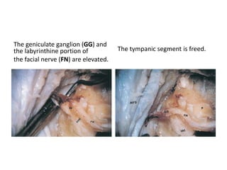 COMBINED APPROACHES
Retrolabyrinthine Transpetrous ( = Transapical
)Subtemporal Approach
Retrolabyrinthine Transpetrous ( = Transapical
)Subtemporal Transtentorial Approach
Retrolabyrinthine Subtemporal
Transapical Approach
Retrolabyrinthine Subtemporal
Transtentorial Approach
 