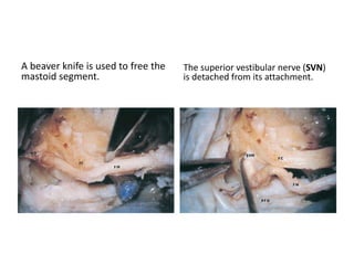 A view of the cerebellopontine angle
through the retrolabyrinthine
approach Note the narrow field and
limited control.
Posterior fossa dura (PFD) structures
exposed through the standard
retrolabyrinthine approach.
A view of the posterior fossa dura
through the combined
retrolabyrinthine subtemporal
transapical approach.
 
