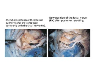 The middle fossa dura has
been cut. The oculomotor
nerve (III) is clearly seen.
With more retraction of the
temporal lobe and the tentorium
(*), the optic nerve (II) is seen.
 