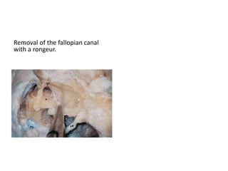 Retrolabyrinthine Subtemporal Transapical
(Transpetrous Apex) Approach
Schematic drawing showing the
incision to be performed.
A retrolabyrinthine approach is
performed.
 