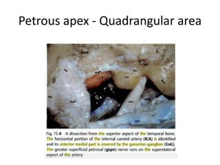 Tranaslabyrinthine Transpetrous [=
Transapical ] approach
After drilling the LSC , PSC & SSC
– IAC is exposed
Transpetrous path is above & below
the IAC & medial to cochlea
 
