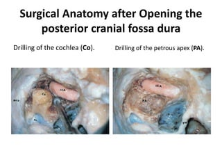 The dura of the middle fossa is
detached from the superior surface of
the temporal bone from posterior to
anterior.
With further detachment of the
dura, the middle meningeal
(MMA) artery is clearly identified.
 