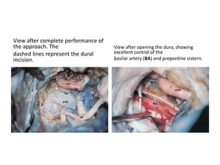 The middle meningeal artery (MMA)
and the three branches
(V1, V2, V3) of the trigeminal nerve
are identified.
View after cutting the middle
meningeal artery (MMA) and
the mandibular branch of the
trigeminal nerve (V).
 
