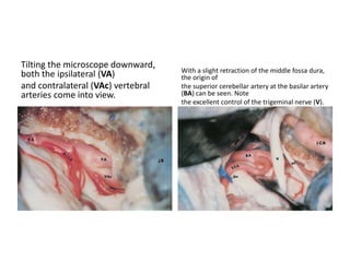 The internal auditory canal (IAC)
is identified.
A large diamond burr is used to
drill the petrous apex.
 