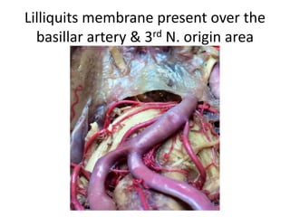 The petrous apex has been
drilled. The internal carotid artery
(ICA) is identified.
At higher magnification, the
abducent nerve (VI) is identified
at the level of the tip of the petrous
apex (PA).
 