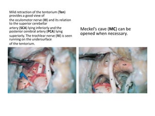 Panoramic view showing the
structures after opening of the
posterior fossa dura.
At higher magnification, the anterior
inferior cerebellar artery (AICA)is
seen stemming from the basilar
artery (BA) at the prepontine cistern.
The artery is crossed by the
abducent nerve (VI). Note the good
control of the prepontine cistern
through this approach.
 