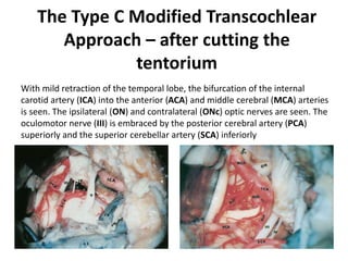 Tilting the microscope downward,
the lower cranial nerves
are well seen.
 