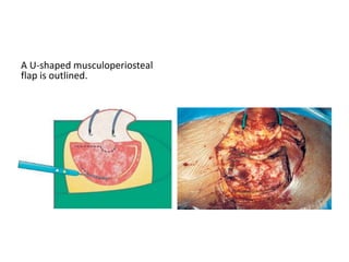 Endoscopic Retrolabyrinthine
approach –
The retrolabyrinthine approach consists of a small posterior
fossa craniotomy, between the sigmoid sinus and the otic
capsule. It provides limited exposure of the posterior fossa,
confined to the region of the entry
zone of the trigeminal nerve and acousticofacial nerve
bundle. More lateral structures, such as the porus
acusticus and the internal auditory canal, cannot be
visualized directly, since they are blocked by the otic
capsule. In order to reach and inspect the interna)
auditory canal, it is necessary first to enlarge the
approach posteriorly, removing the bone overlying the
sigmoid sinus and 1-2 cm of the retrosigmoid occipital
bone; and secondly, to use the endoscopic procedure .
 