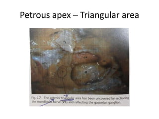 The Enlarged Translabyrinthine Approach with Transpetrous ( =
Transapical ) Extension – intradurally above the IAC you will get 5th nerve
where below the IAC you will get 6th nerve & lower cranial nerves .
Schematic drawings showing the amount of bone removal
around the internal auditory canal in the different variants of the
translabyrinthine approach. Note that in the transapical modification the
exposure is 320° and about 360° in types I and II, respectively. Abbreviations
as in Fig. 5.1. cn, cranial nerve; CN, cochlear nerve; FN, facial nerve;
IV, inferior vestibular nerve; SV, superior vestibular nerve.
 