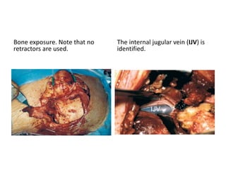 Translabyrinthine Transpetrous (
= Transapical )
 